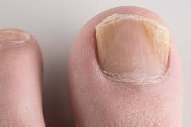 nail infection
